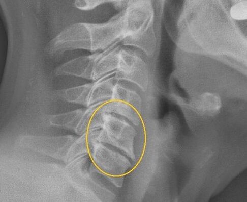 X -ray-da servikal belin osteokondrozu