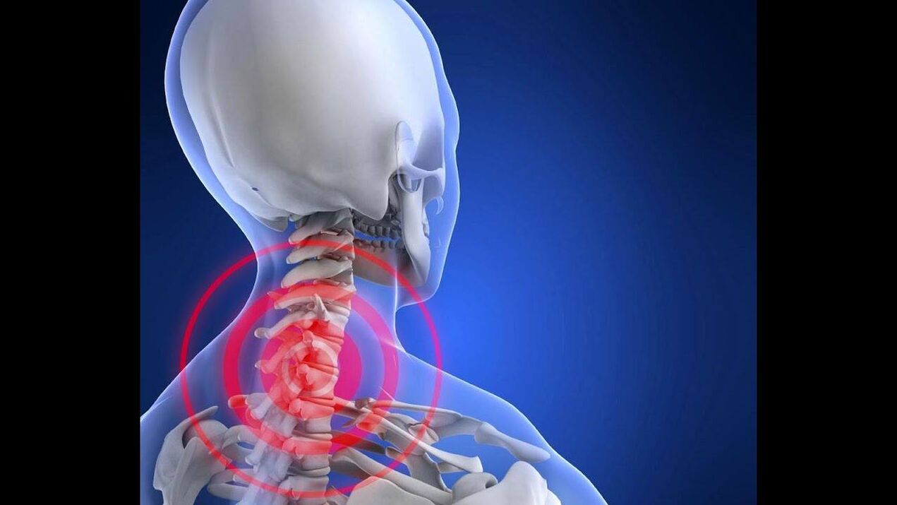 Servikal onurğanın osteoxondrozu